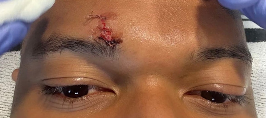 Mbappé ukázal sešitý nadočnicový oblouk